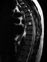 Bone Hemangioma Imaging