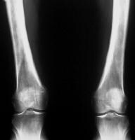 Imaging in Hypertrophic Osteoarthropathy: Overview, Radiography ...