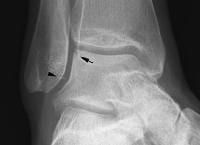 Osteochondritis Dissecans Imaging