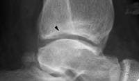 Osteochondritis Dissecans Imaging