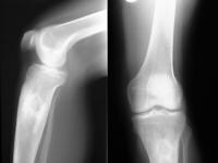 Chronic Osteomyelitis Imaging: Overview, Radiography, Computed Tomography