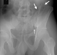 Pelvic Ring Fracture Imaging: Overview, Computed Tomography, Magnetic ...