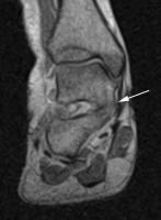 Tarsal Coalition Imaging: Overview, Radiography, Computed Tomography