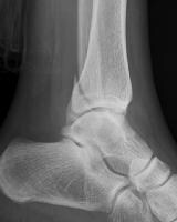 Imaging in Ankle Fractures: Overview, Radiography, Computed Tomography