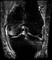 Collateral Ligament Injury MRI: Overview, Radiography, Computed Tomography