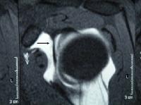 Glenoid Labrum Injury MRI: Overview, Radiography, Computed Tomography