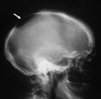 Encephalocele Imaging: Overview, Radiography, Computed Tomography