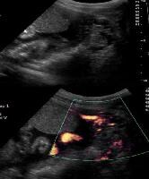 Subchorionic Hemorrhage