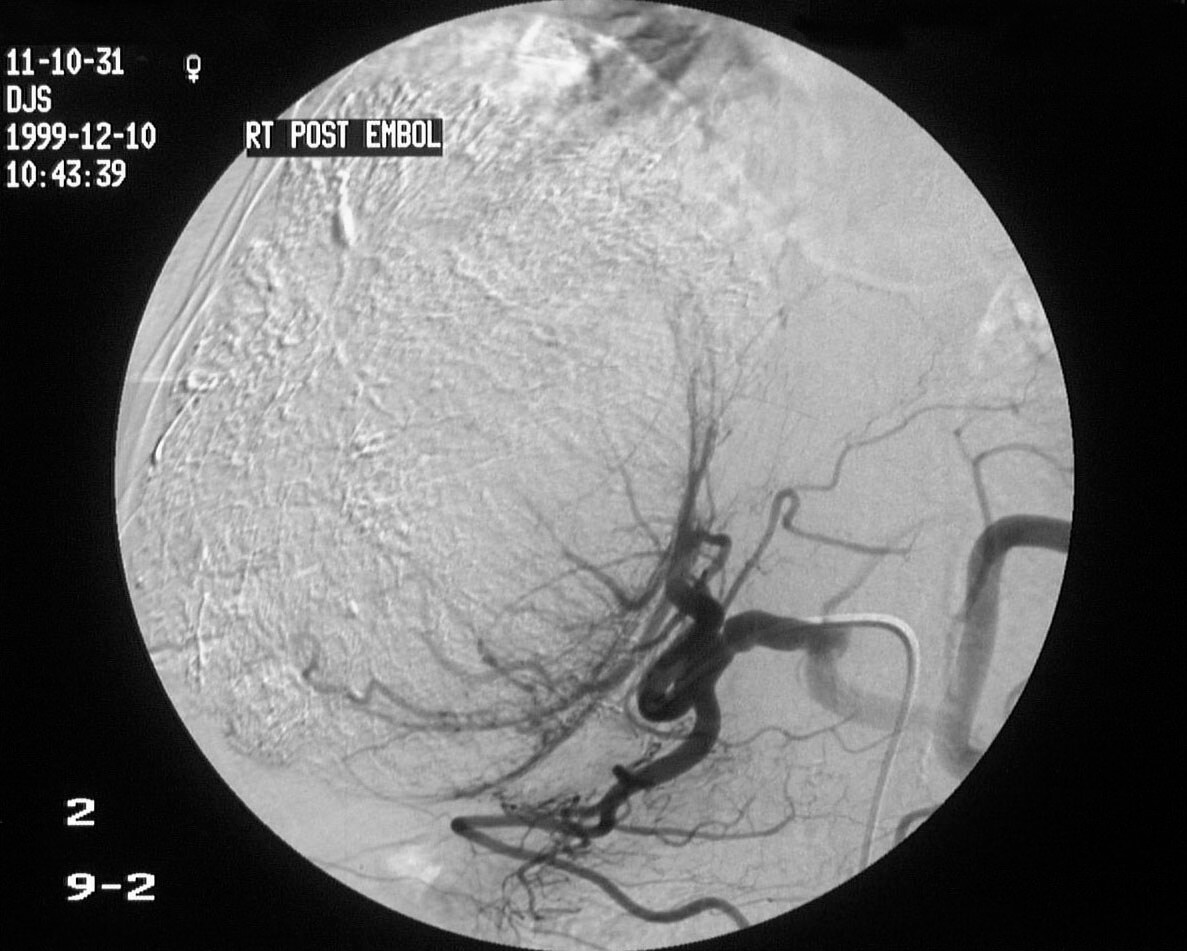 Hypodense hepatic lesion >> hepatic lobe lesion - definition of a ...