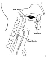 Dysphagia