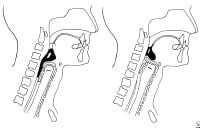 Dysphagia