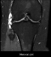 Cystic Lesions About the Knee