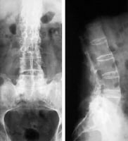 Ankylosing Spondylitis and Undifferentiated Spondyloarthropathy Workup ...