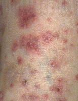 Microscopic Polyangiitis Clinical Presentation