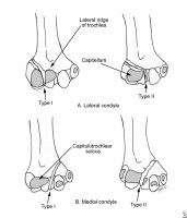 Medial Condylar Fracture of the Elbow ~ Sports Medicine