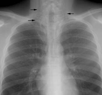 Ana Ansorullah: Homework ku( tension pneumothorax)