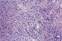 A nonspecific, mixed inflammatory infiltrate that 