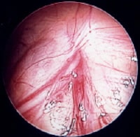 Laparoscopic view of normal vas deferens and testi