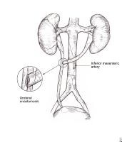 Ureteral Trauma Treatment & Management