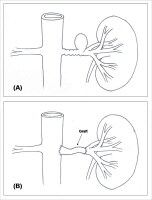 Renal Artery Aneurysm Treatment & Management