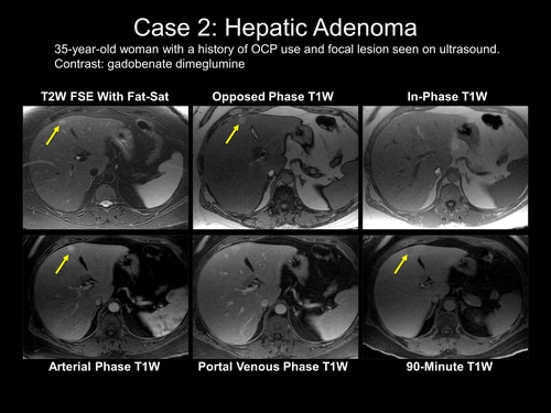 liver-imaging-with-mri