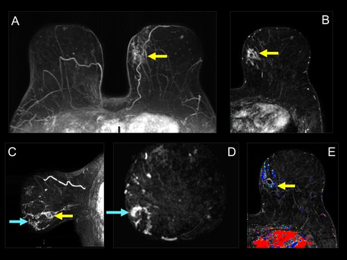 Breast Imaging With MRI