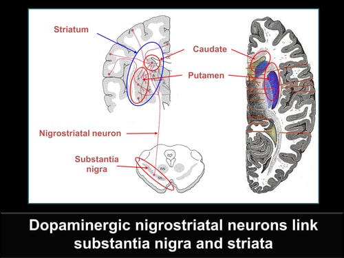 How to Use Dopaminergic Imaging to Distinguish Parkinson Disease From