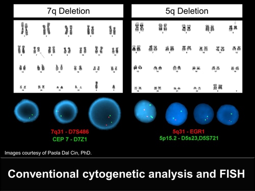 Clinical And Histologic Evaluation Of Myelodysplastic Syndrome