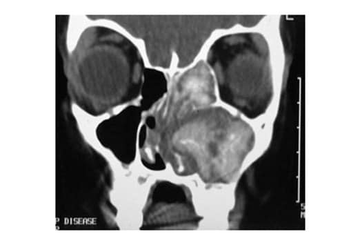 Fungal Sinusitis Mri