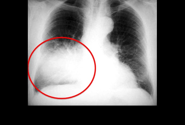 mri fluid does show A Rash Presentation MRSA: for Chronic, Case Scaly Mistaken