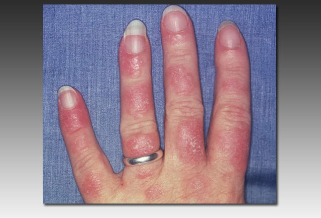 Dermatitis Herpetiformis - WebMD