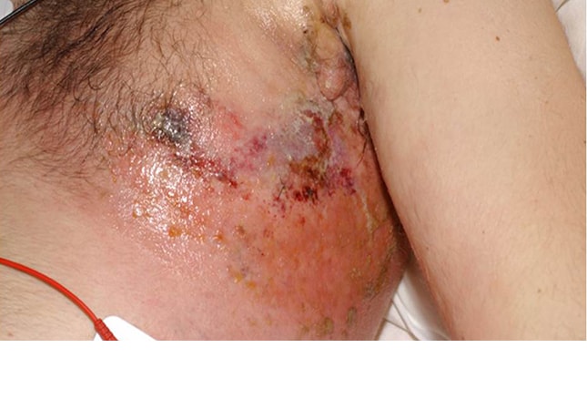 What is Chemo Rash?