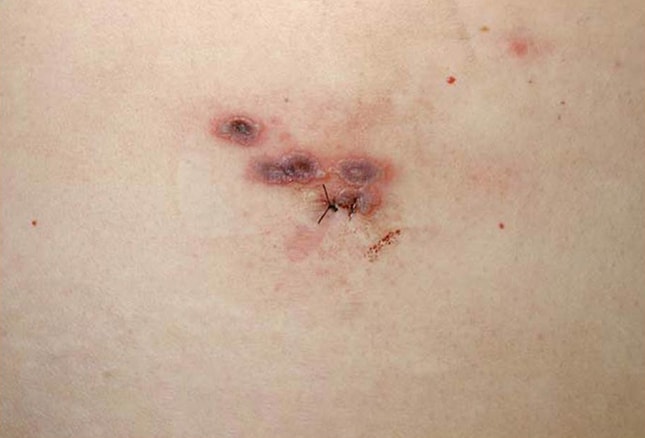 14 Skin Lesions Caused By Cancer Chemotherapy