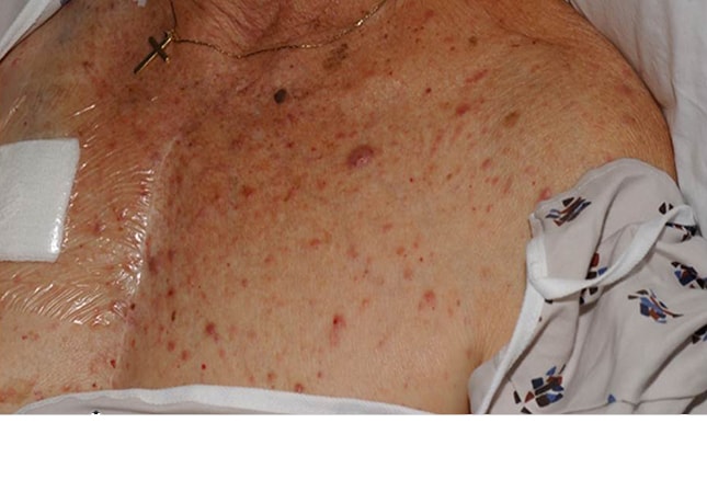 14 Skin Lesions Caused by Cancer Chemotherapy