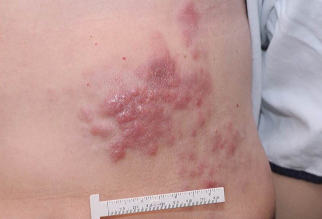 14 Skin Lesions Caused by Cancer Chemotherapy