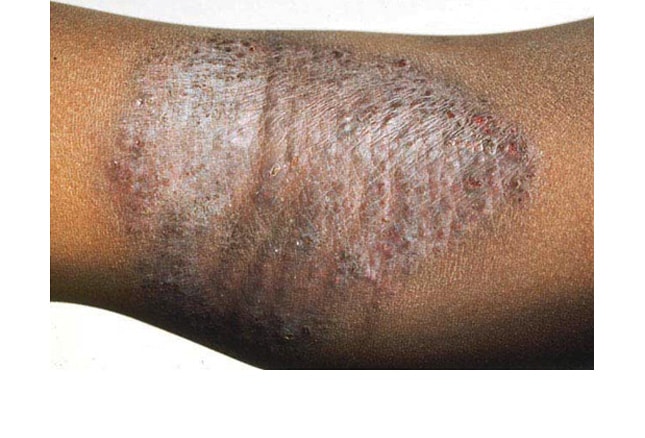 Eczema of legs on Black skin with erythema and lichenification