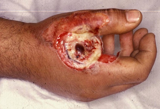 Electrical Injuries: Slideshow