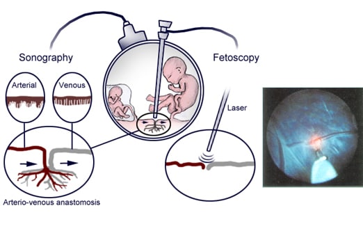 Fetal Surgery