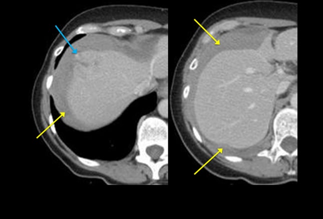 A 61-Year-Old Woman with Radiating Abdominal Pain: Case Presentation