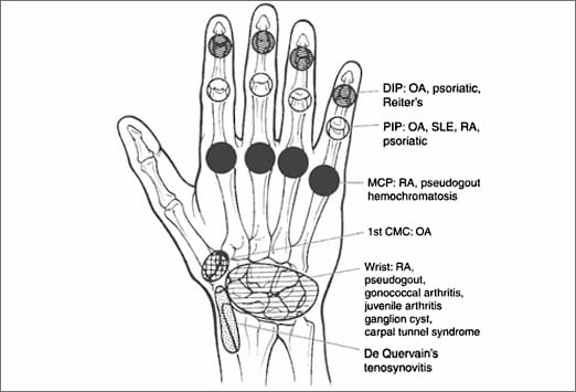 Notable Knuckles, Part 2: Evaluating More Arthritides of the Hand