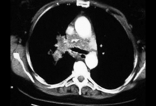 Lung Cancer: Keys to Radiographic Assessment and Staging