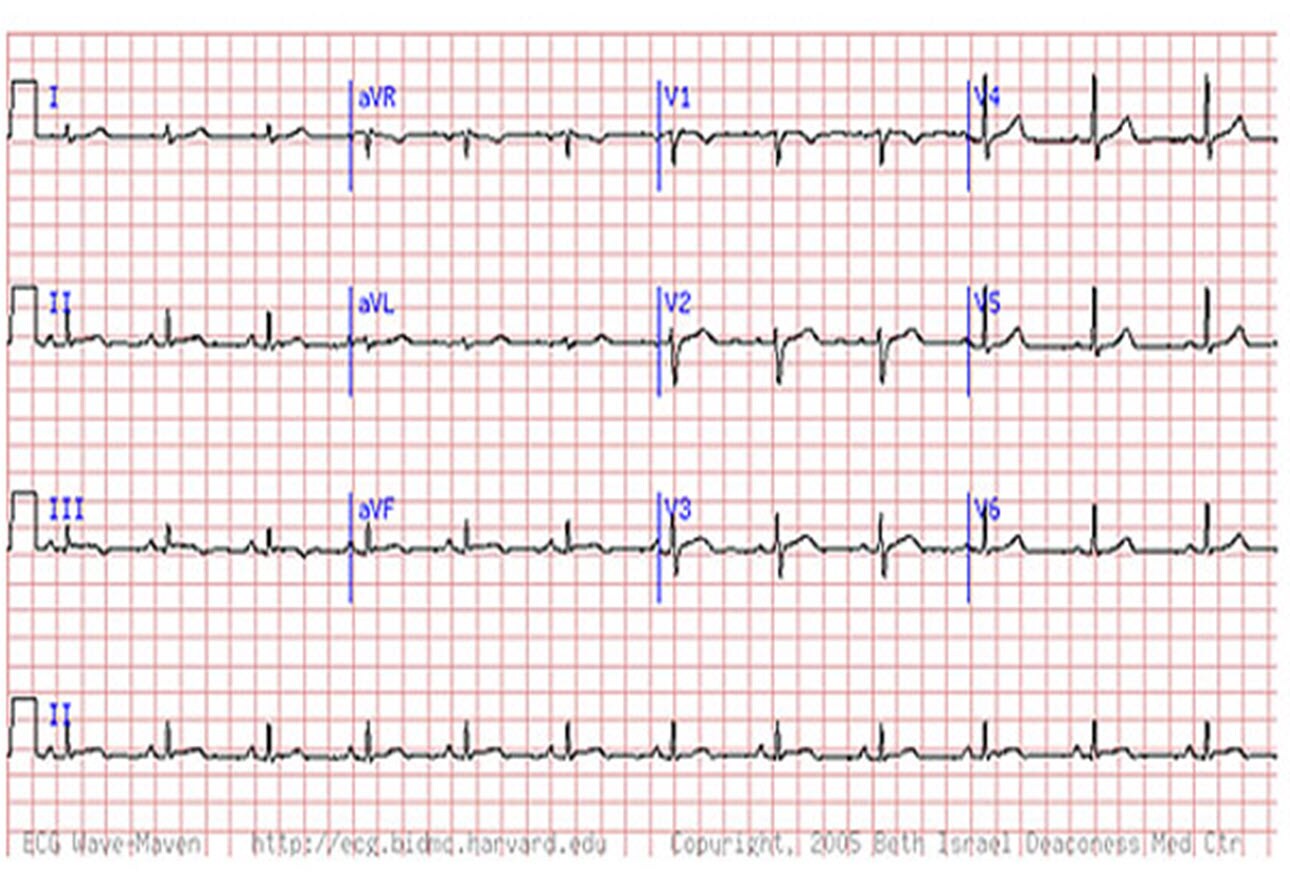 Are You Missing Subtle MI Clues on ECGs? Test Your Skills