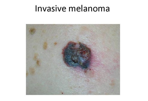 Mole or Melanoma? Tell-Tale Signs in Benign Nevi and Malignant Melanoma ...