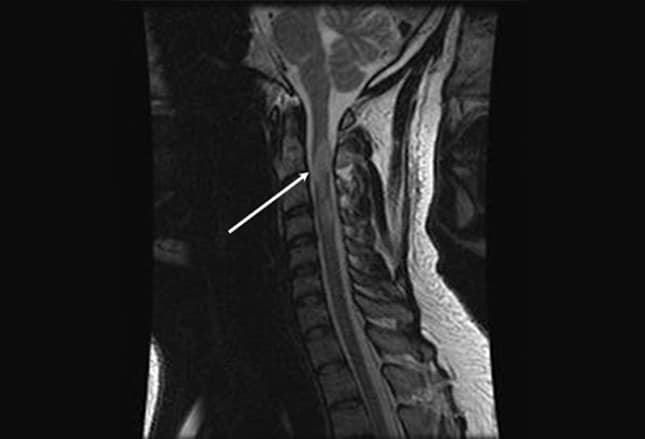 Multiple Sclerosis: Slideshow