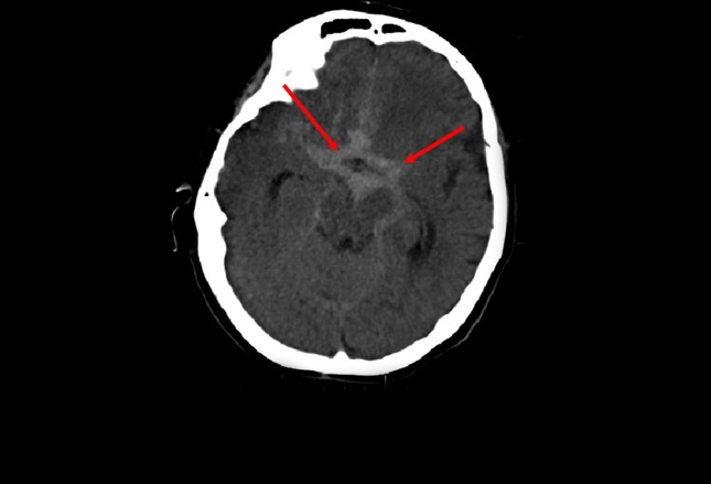 Can't-Miss Findings on Noncontrast Head CT: Slideshow