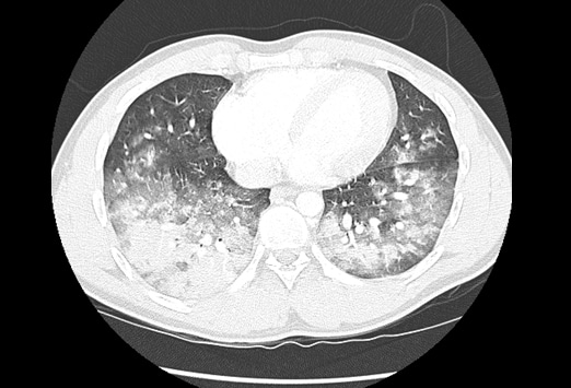 Persistent Productive Cough and Fever: Case Presentation