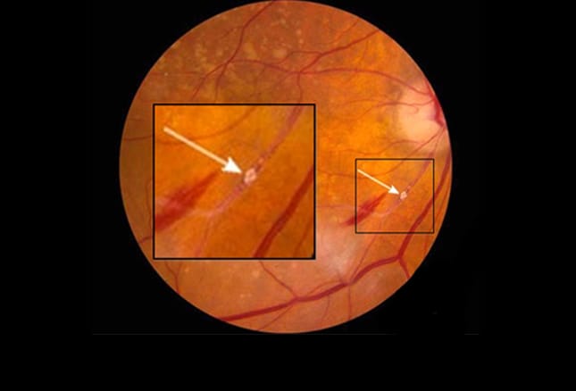 Retina Abnormalities: 14 Signs Of Systemic Disease