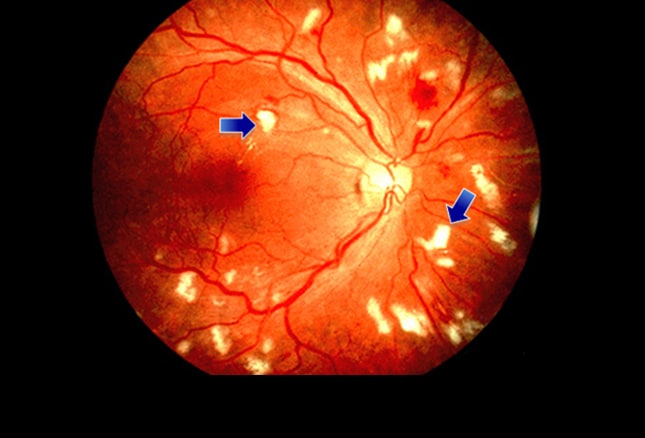 dark spot on retina scan