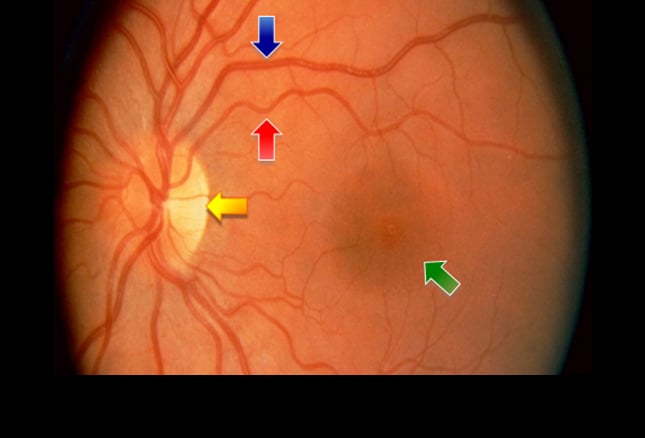 glaucoma findings on fundoscopic exam