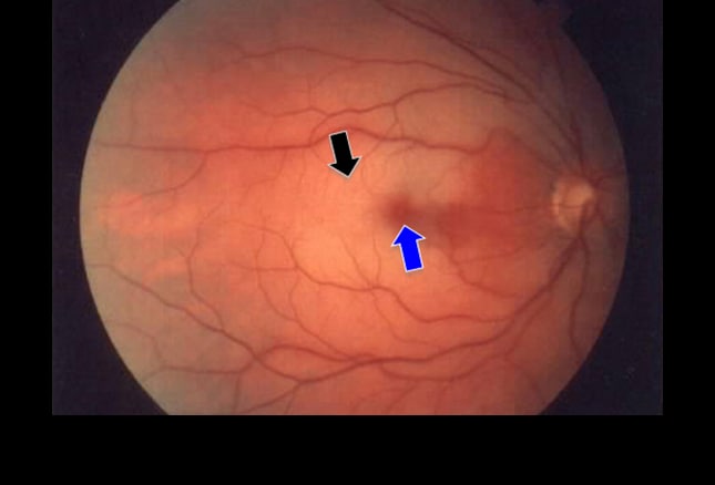 dark spot on retina scan